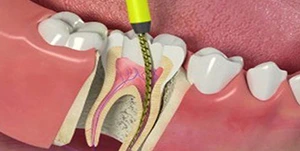 root-canal